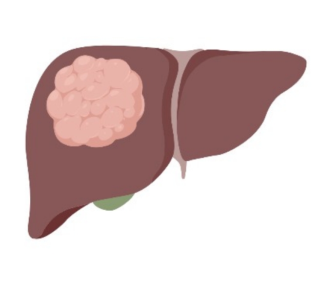 liver cancer